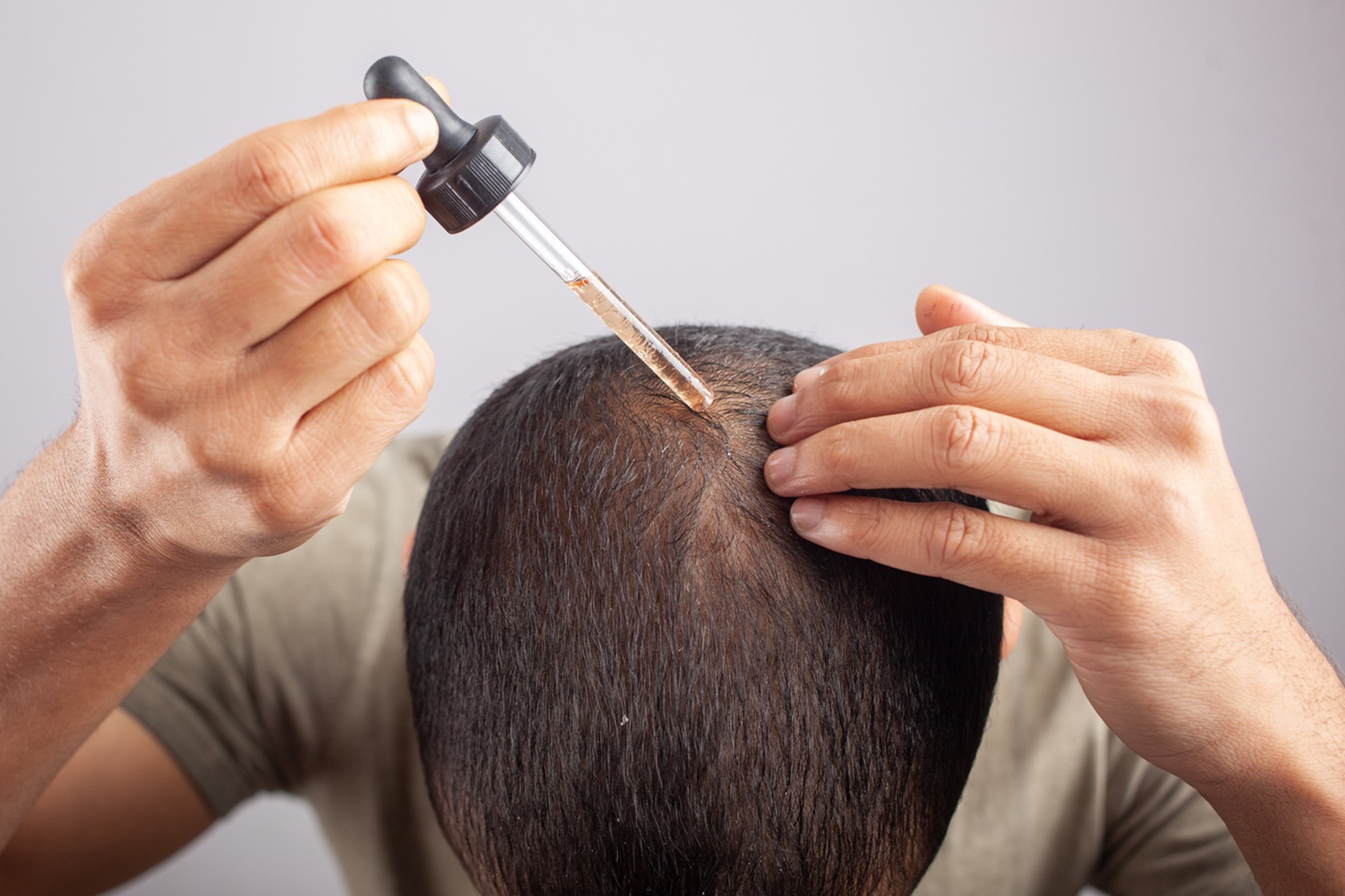 Is Glycolic Acid the Next Hair Loss “Hack” – or a Hidden Risk?